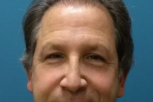 mens-before-and-after-patient-17-b mens-before-and-after-patient-17-b