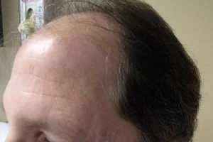 mens-before-and-after-patient-17-c mens-before-and-after-patient-17-c