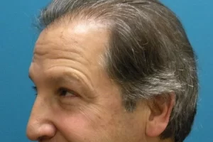 mens-before-and-after-patient-17-d mens-before-and-after-patient-17-d