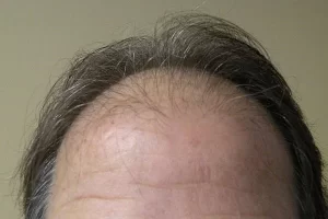 mens-before-and-after-patient-17-e mens-before-and-after-patient-17-e