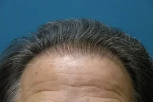 mens-before-and-after-patient-17-f mens-before-and-after-patient-17-f