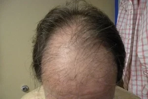 mens-before-and-after-patient-17-g mens-before-and-after-patient-17-g