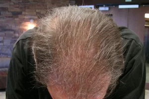 mens-before-and-after-patient-17-h mens-before-and-after-patient-17-h