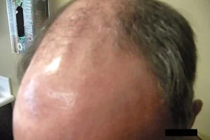 mens-before-and-after-patient-18-c mens-before-and-after-patient-18-c