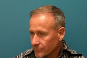 mens-before-and-after-patient-18-d mens-before-and-after-patient-18-d