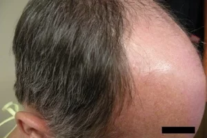 mens-before-and-after-patient-18-e mens-before-and-after-patient-18-e