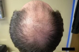 mens-before-and-after-patient-18-g mens-before-and-after-patient-18-g
