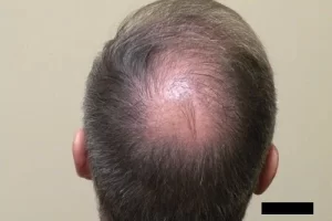 mens-before-and-after-patient-18-h mens-before-and-after-patient-18-h