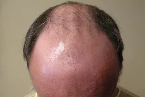 mens-before-and-after-patient-18-i mens-before-and-after-patient-18-i