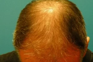 mens-before-and-after-patient-18-j mens-before-and-after-patient-18-j