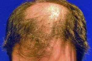 mens-before-and-after-patient-19-a mens-before-and-after-patient-19-a