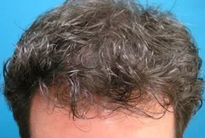 mens-before-and-after-patient-19-b mens-before-and-after-patient-19-b
