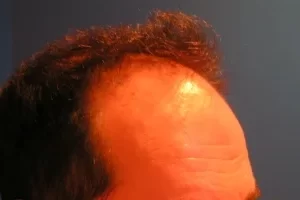 mens-before-and-after-patient-19-c mens-before-and-after-patient-19-c