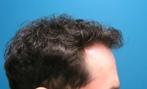 mens-before-and-after-patient-19-d mens-before-and-after-patient-19-d