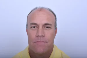 mens-before-and-after-patient-2-a mens-before-and-after-patient-2-a