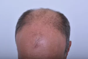mens-before-and-after-patient-2-c mens-before-and-after-patient-2-c
