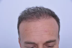 mens-before-and-after-patient-2-d mens-before-and-after-patient-2-d