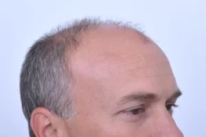 mens-before-and-after-patient-2-e mens-before-and-after-patient-2-e
