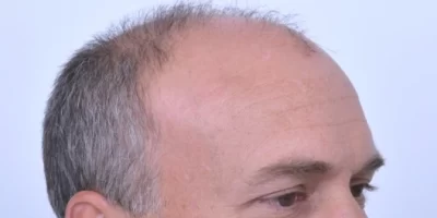 mens-before-and-after-patient-2-e mens-before-and-after-patient-2-e