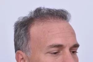 mens-before-and-after-patient-2-f mens-before-and-after-patient-2-f