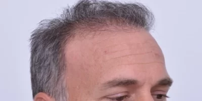 mens-before-and-after-patient-2-f mens-before-and-after-patient-2-f