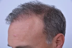mens-before-and-after-patient-2-h mens-before-and-after-patient-2-h