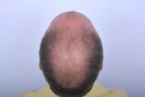 mens-before-and-after-patient-2-i mens-before-and-after-patient-2-i
