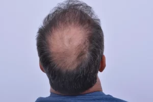 mens-before-and-after-patient-2-j mens-before-and-after-patient-2-j