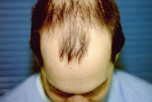 mens-before-and-after-patient-20-a mens-before-and-after-patient-20-a