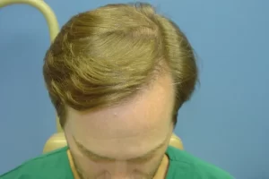 mens-before-and-after-patient-20-b mens-before-and-after-patient-20-b