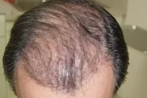mens-before-and-after-patient-21-c mens-before-and-after-patient-21-c