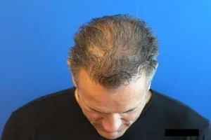 mens-before-and-after-patient-21-d mens-before-and-after-patient-21-d