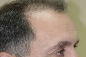 mens-before-and-after-patient-21-e mens-before-and-after-patient-21-e