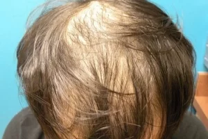 mens-before-and-after-patient-22-a mens-before-and-after-patient-22-a
