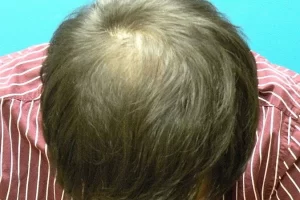 mens-before-and-after-patient-22-b mens-before-and-after-patient-22-b