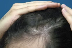 mens-before-and-after-patient-22-d mens-before-and-after-patient-22-d