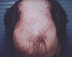 mens-before-and-after-patient-23-c mens-before-and-after-patient-23-c