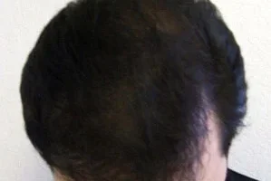 mens-before-and-after-patient-23-d mens-before-and-after-patient-23-d