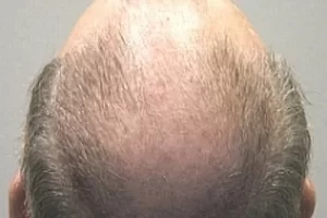 mens-before-and-after-patient-24-a mens-before-and-after-patient-24-a