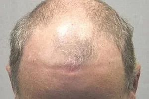 mens-before-and-after-patient-24-c mens-before-and-after-patient-24-c