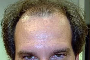 mens-before-and-after-patient-25-a mens-before-and-after-patient-25-a