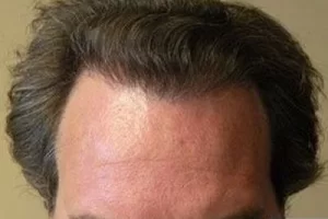 mens-before-and-after-patient-25-b mens-before-and-after-patient-25-b