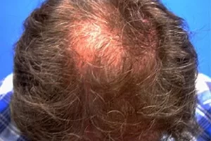 mens-before-and-after-patient-25-c mens-before-and-after-patient-25-c