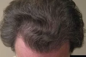 mens-before-and-after-patient-25-d mens-before-and-after-patient-25-d