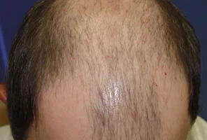 mens-before-and-after-patient-26-a mens-before-and-after-patient-26-a