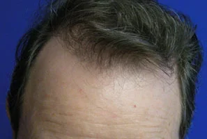 mens-before-and-after-patient-26-b mens-before-and-after-patient-26-b