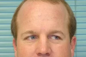 mens-before-and-after-patient-27-a mens-before-and-after-patient-27-a