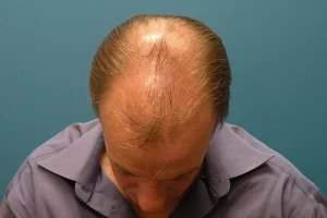 mens-before-and-after-patient-29-a mens-before-and-after-patient-29-a