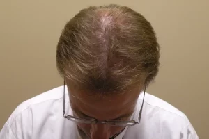 mens-before-and-after-patient-29-b mens-before-and-after-patient-29-b
