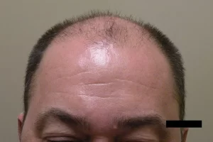 mens-before-and-after-patient-3-a mens-before-and-after-patient-3-a
